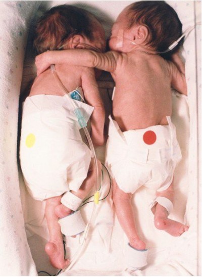 bungaca:

katadurita:

sahilcripnigga:

This picture is from an article called “The Rescuing Hug”. The article details the first week of life of a set of twins. Each were in their respective incubators and one was not expected to live. A hospital nurse fought against the hospital rules and placed the babies in one incubator. When they were placed together, the healthier of the two threw an arm over her sister in an endearing embrace. The smaller baby’s heart stabilized and temperature rose to normal.

Subhanallah :)

Kelak makin pengen punya anak kembar :)
