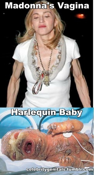 Madonna's Vagina Harlequin Baby aka Steak Left Out in the Sun