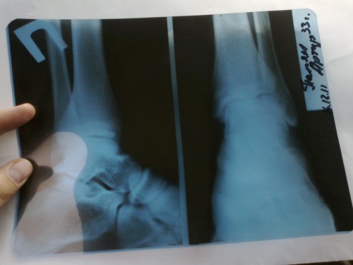 x-ray of my ankle